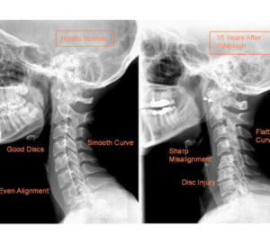 normal neck curve before accident vs after accident altered curve